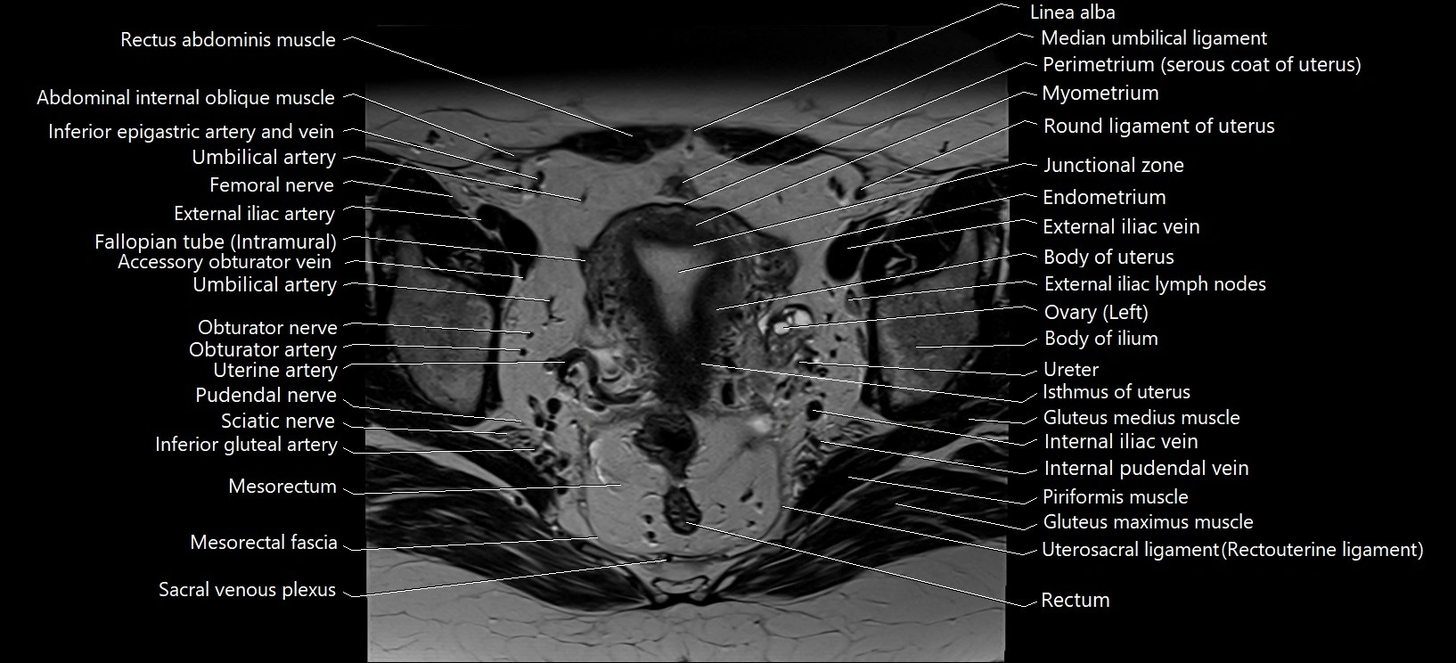 Axial cross sectional anatomy of female pelvis (MRI 3T) image 17.webp